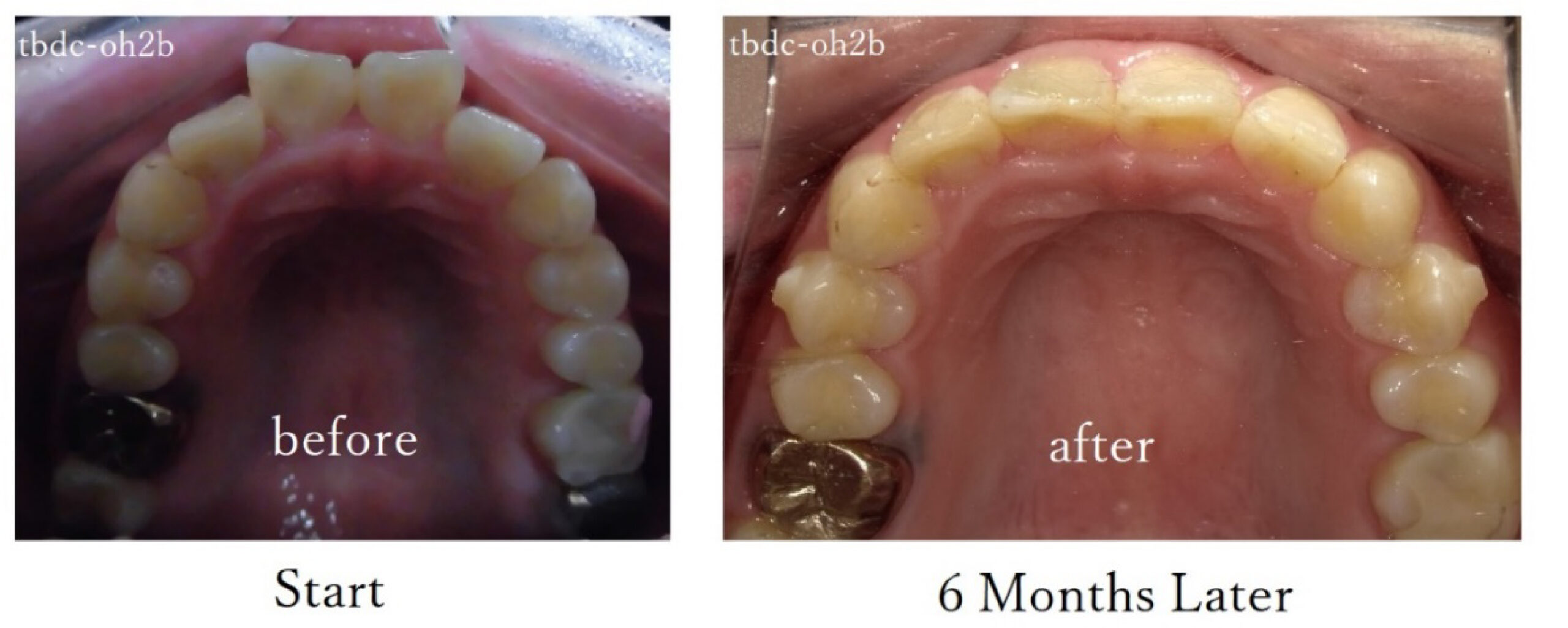Before/After