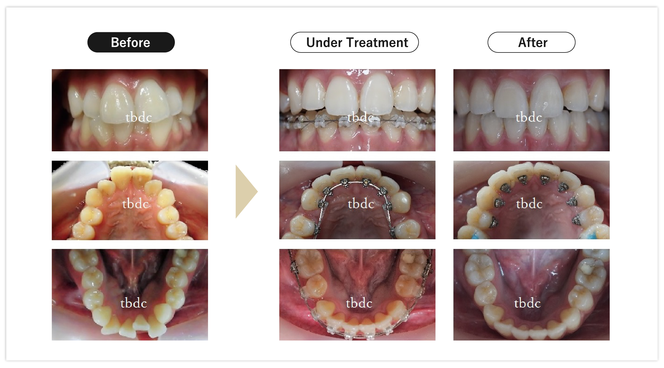Before/After