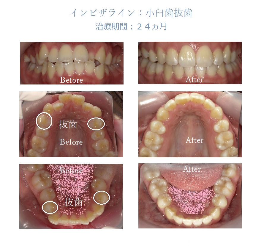 治療例1:インビザライン:小臼歯抜歯