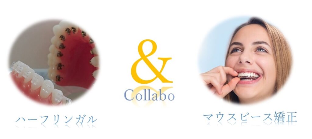 ハーフリンガルとマウスピース矯正のコラボ矯正