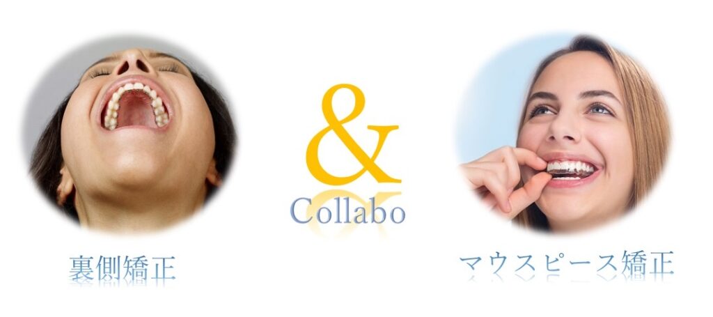 裏側矯正とマウスピース矯正のコラボ矯正