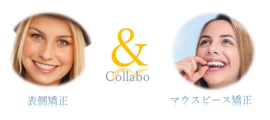表側矯正とマウスピース矯正のコラボ矯正