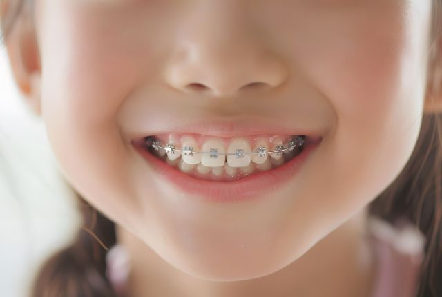 矯正をした子供の口元